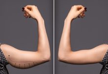 Você conhece a cirurgia plástica para melhorar o braço do tchauzinho?