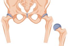 Clinica Ortopédica Goiânia - Conheça os tipos de Artroplastia de Quadril