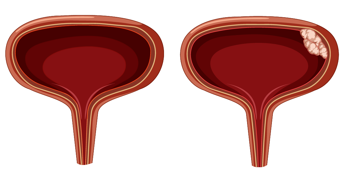 Clínica Urologia de Goiânia - Câncer de bexiga quando suspeitar