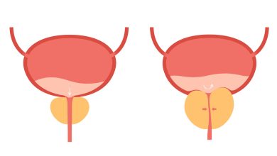 Dr Marco Túlio Cruvinel - Conheça a indicação da cirurgia de HoLEP para aumento de próstata