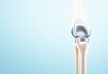 Ortopedia Goiânia - Qual a durabilidade de uma prótese de joelho