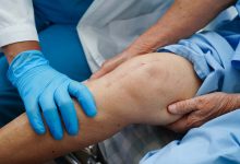 Ortopedia Goiânia - Como funciona a prótese de joelho?