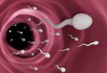 Urologia Goiânia - Relação da varicocele com a infertilidade
