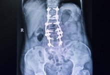 Ortopedia Goiânia - Quando a artrodese da coluna é indicada?