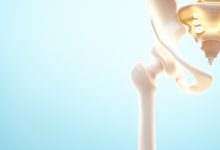 Ortopedia Goiânia - A recuperação após artroscopia de quadril