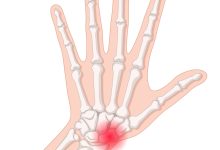 Ortopedia Goiânia - Quais as causas de fratura do escafoide