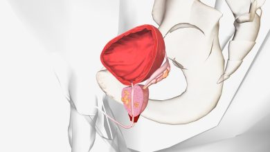 Urologia Aparecida de Goiânia - Quando a prostatectomia radical é indicada?