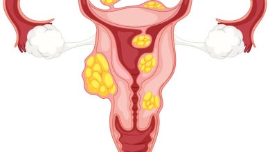 Miomas uterino qual tipo de ultrassom fazer