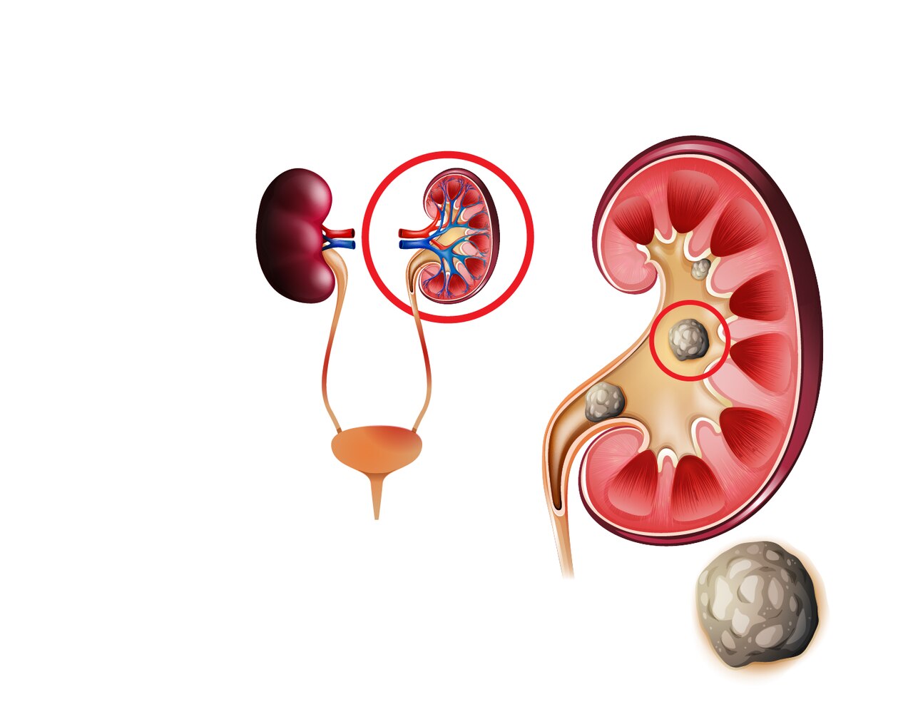 Urologista Aparecida de Goiânia - Quando a nefrolitotripsia percutânea é indicada?