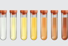 Urologia Goiânia - Qual foi a cor da sua urina esta manhã?