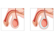 Urologia Goiânia - Qual o tratamento cirúrgico da hidrocele?