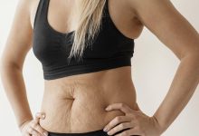 Goiânia - Tenho diástase abdominal, é indicado a abdominoplastia?