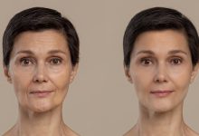 Dr. Reyner Abrantes Stival - Quer remover rugas e flacidez do rosto e rejuvenescer! Conheça o Lifting Facial