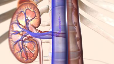 Cirurgia para câncer de rim quando optar por nefrectomia parcial ou total