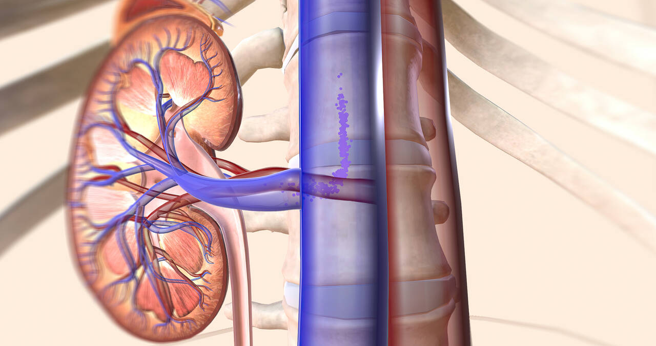 Cirurgia para câncer de rim quando optar por nefrectomia parcial ou total